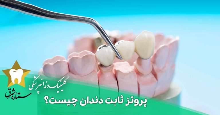 پروتز ثابت دندان چیست؟