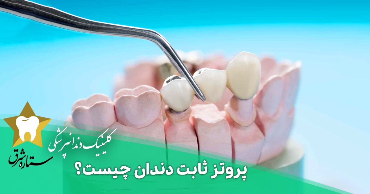پروتز ثابت دندان چیست؟