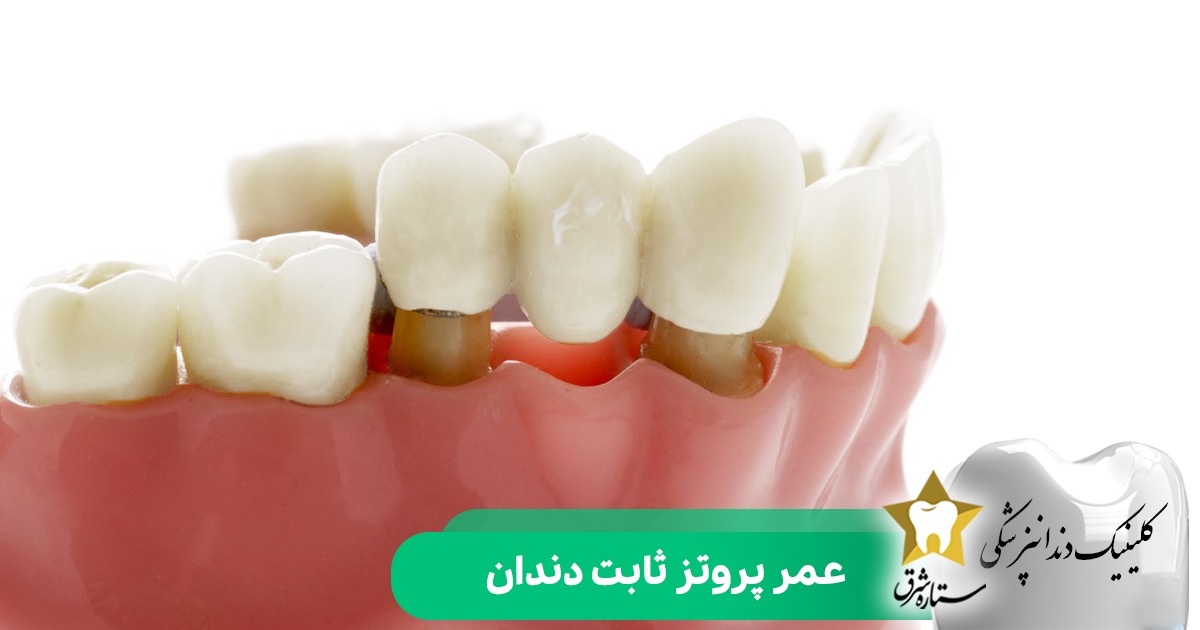 عمر پروتز ثابت دندان