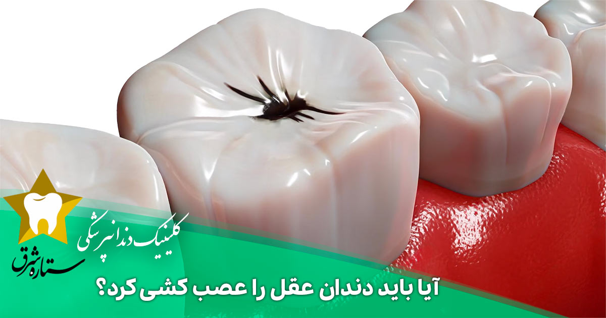 آیا باید دندان عقل را عصب کشی کرد؟