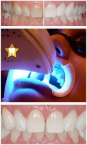 سفید کردن کلینیکی دندان