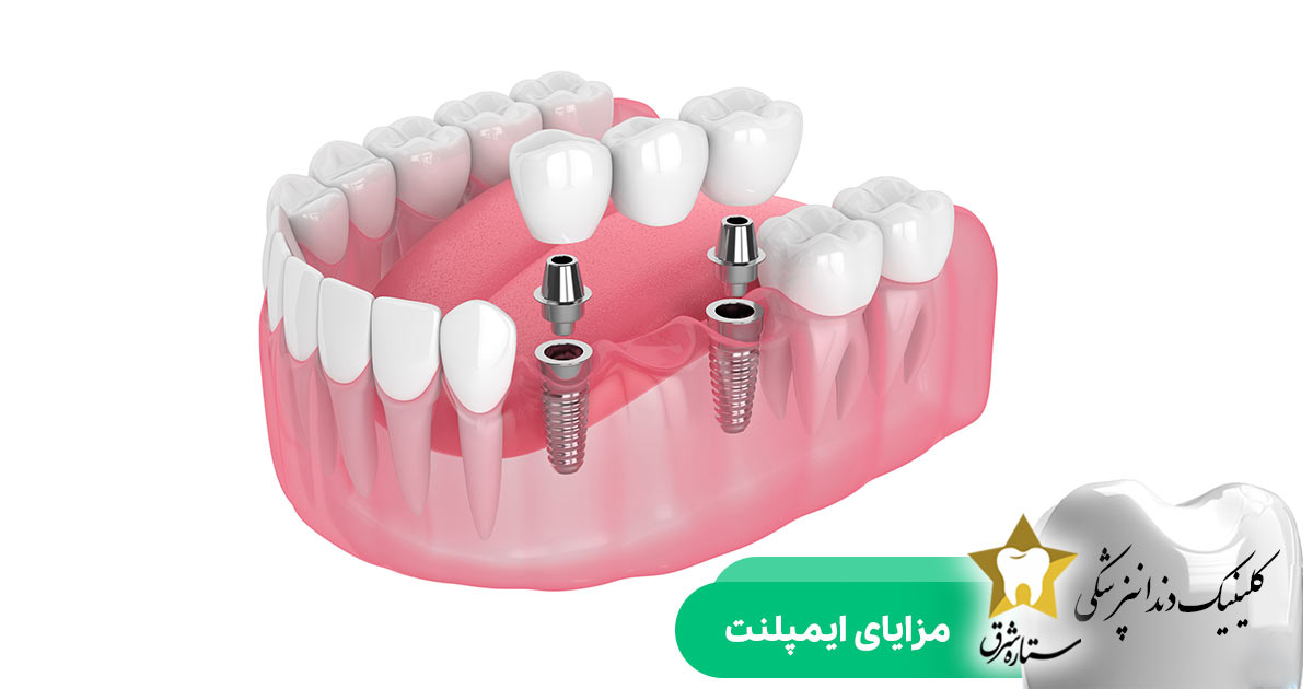 مزایای ایمپلنت