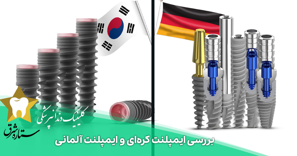 ایمپلنت کره ای بهتر است یا آلمانی