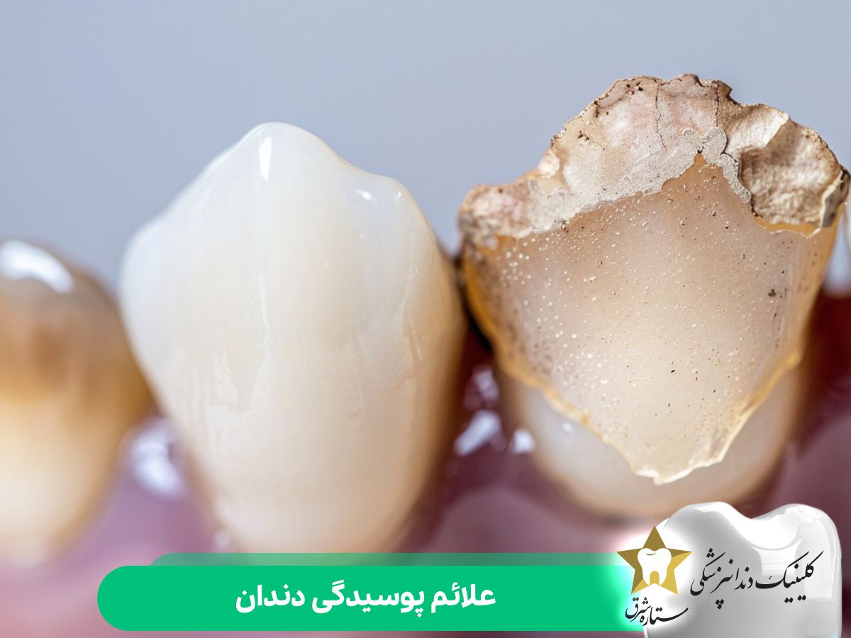 علائم پوسیدگی دندان