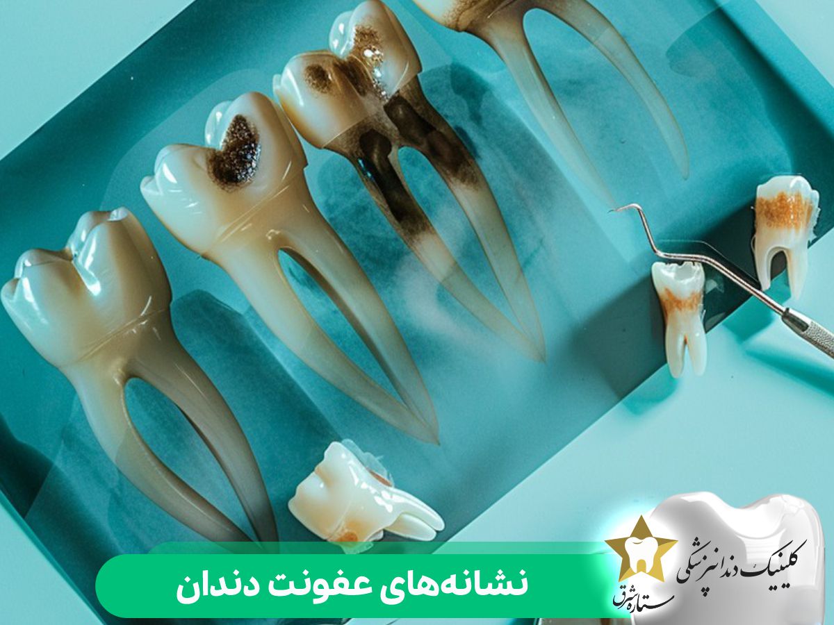 نشانه‌های عفونت دندان