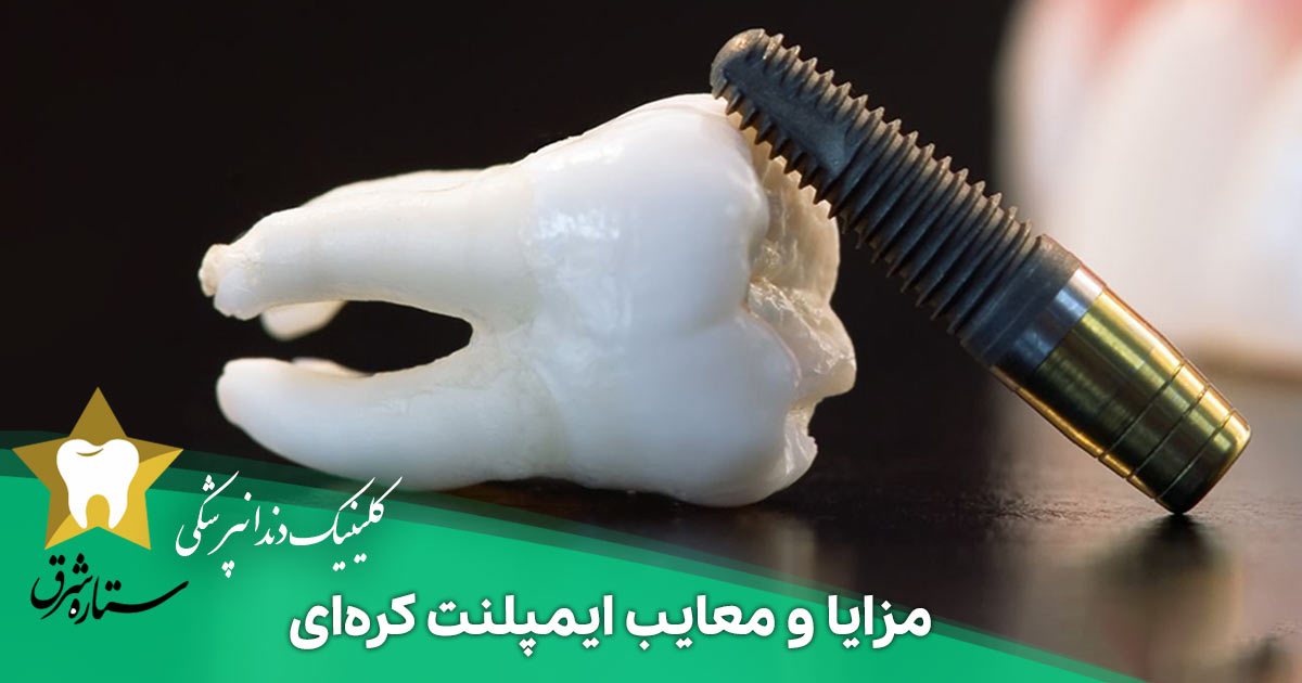 مزایا و معایب ایمپلنت کره‌ای