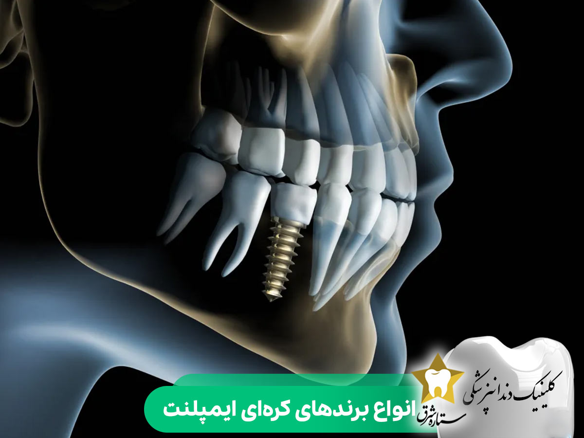 انواع برندهای کرهای ایمپلنت