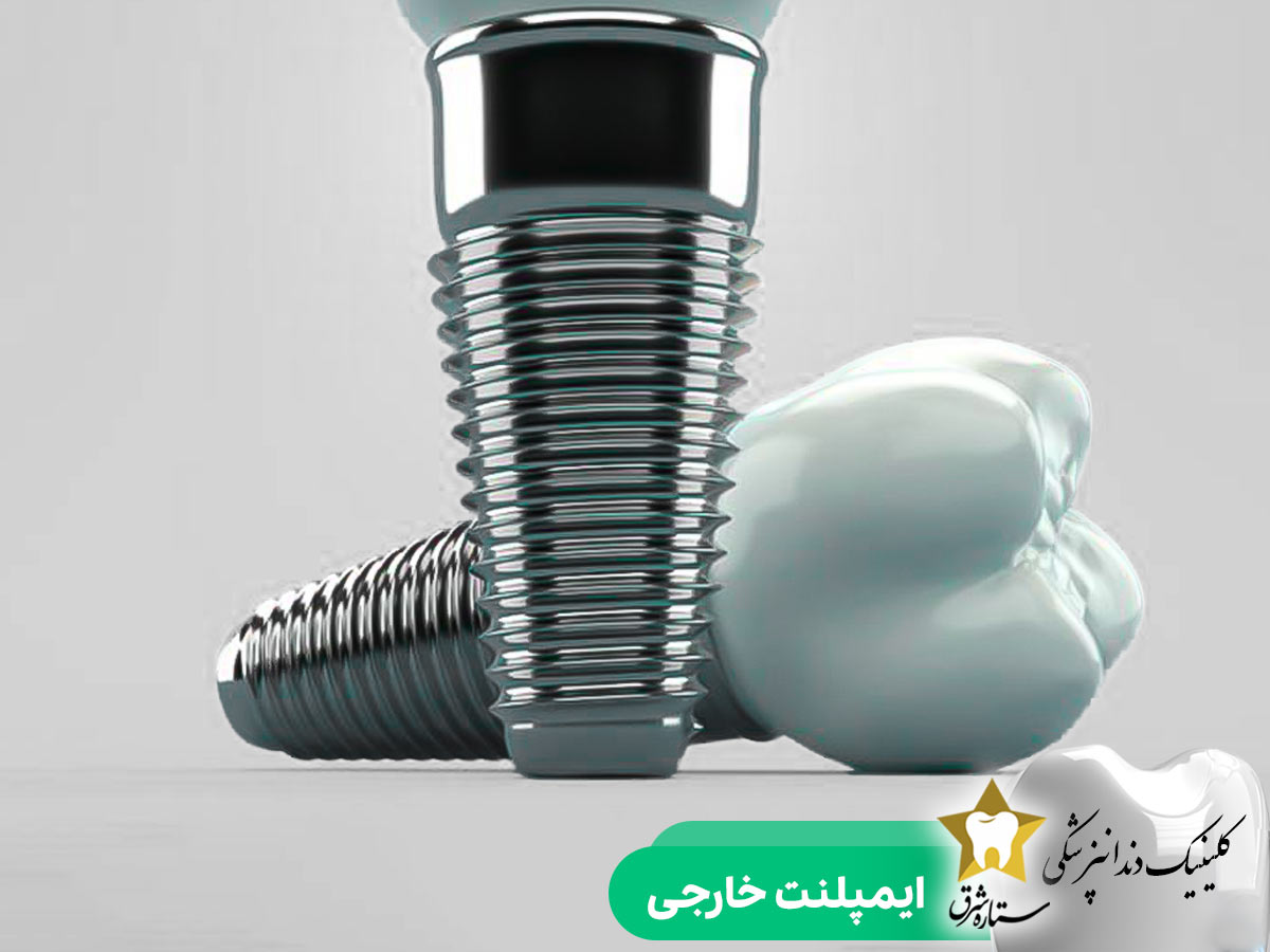 ایمپلنت خارجی