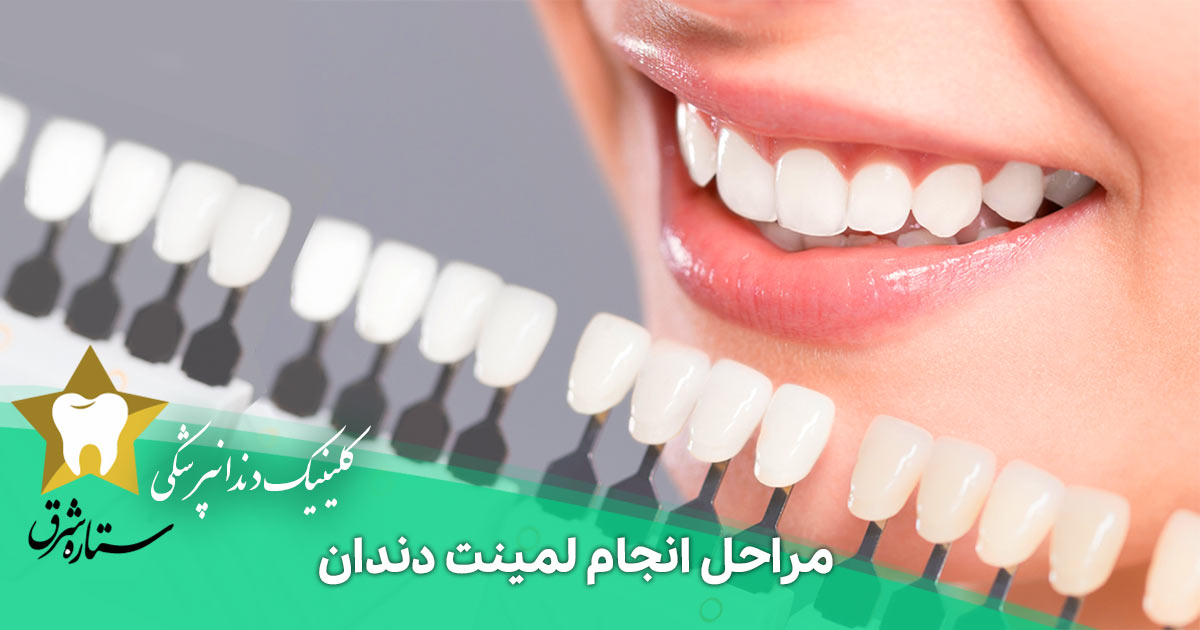 مراحل انجام لمینت دندان چگونه است؟