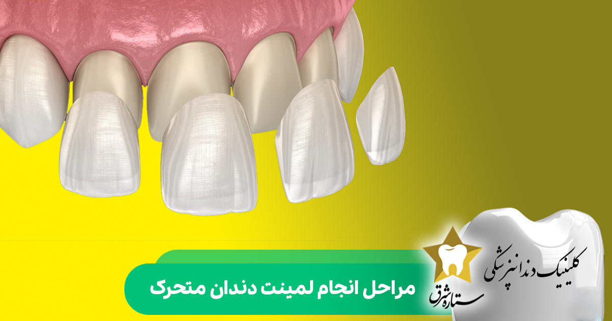 مراحل انجام لمینت دندان متحرک