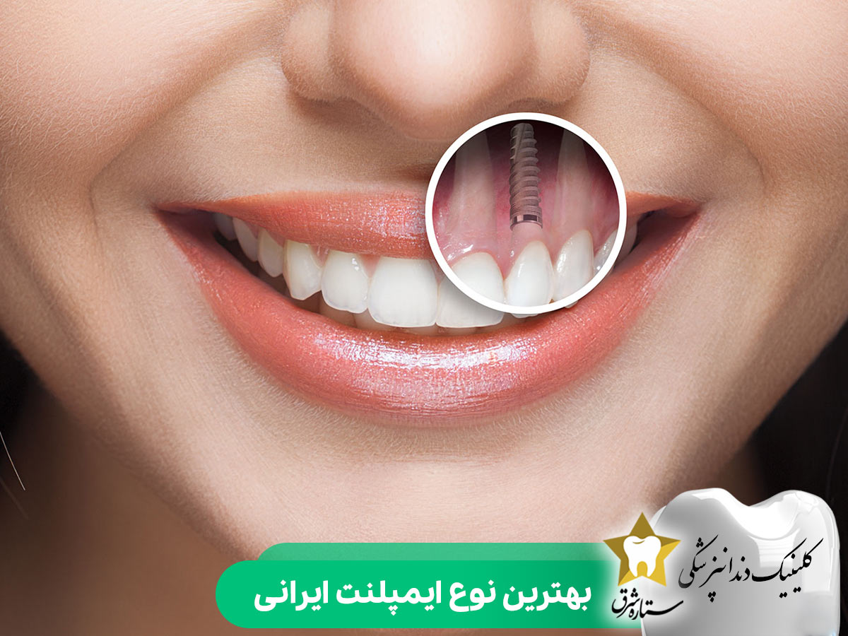 بهترین نوع ایمپلنت ایرانی