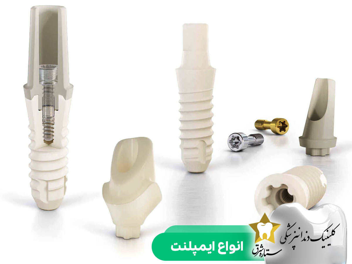انواع ایمپلنت