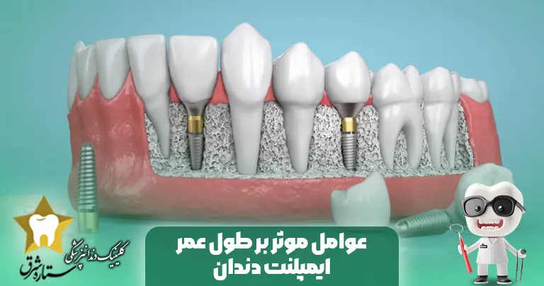 عمر ایمپلنت دندان چقدر است؟