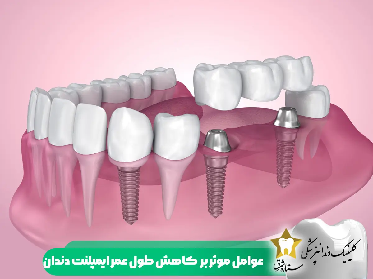 عوامل موثر بر کاهش طول عمر ایمپلنت دندان