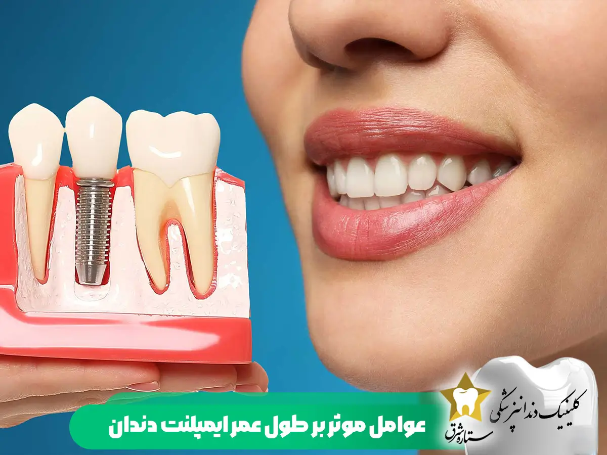عوامل موثر بر طول عمر ایمپلنت دندان