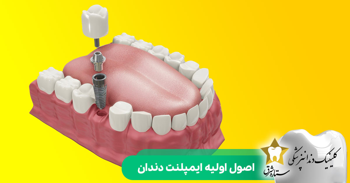 اصول اولیه ایمپلنت دندان