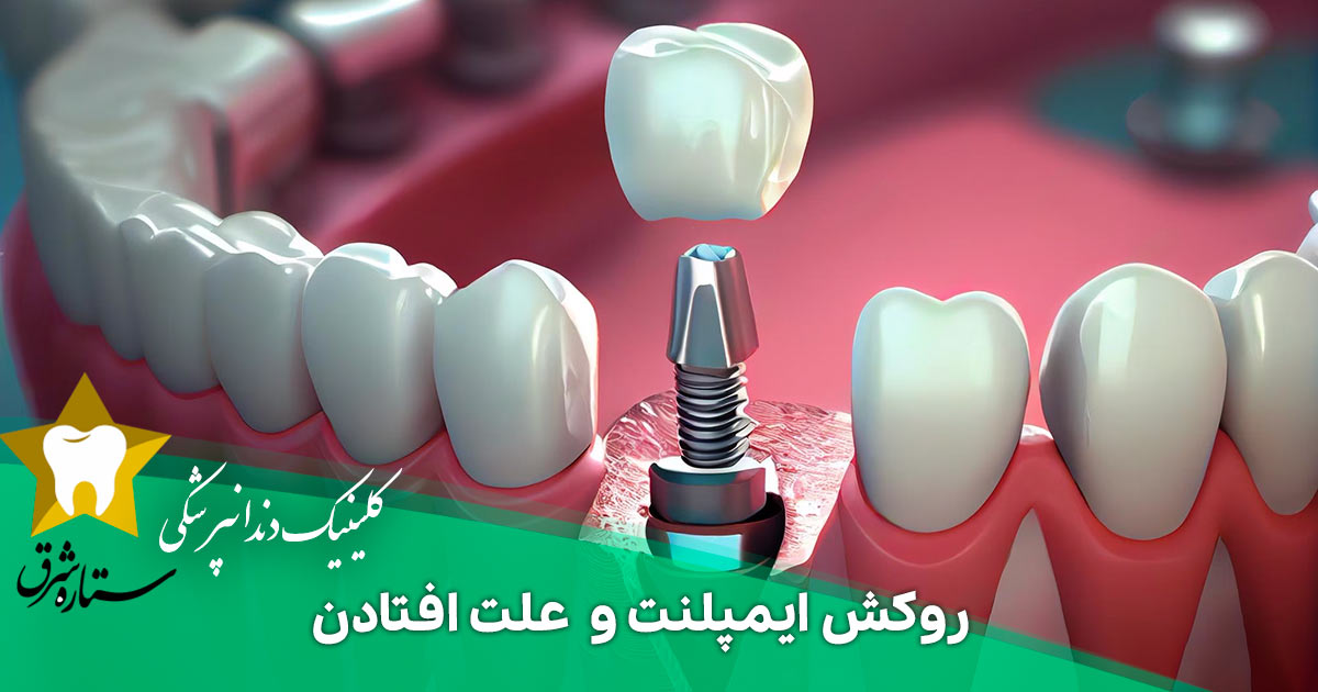 روکش ایمپلنت و همه چیز درباره علت افتادن