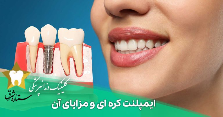 ایمپلنت کره ای و مزایای آن