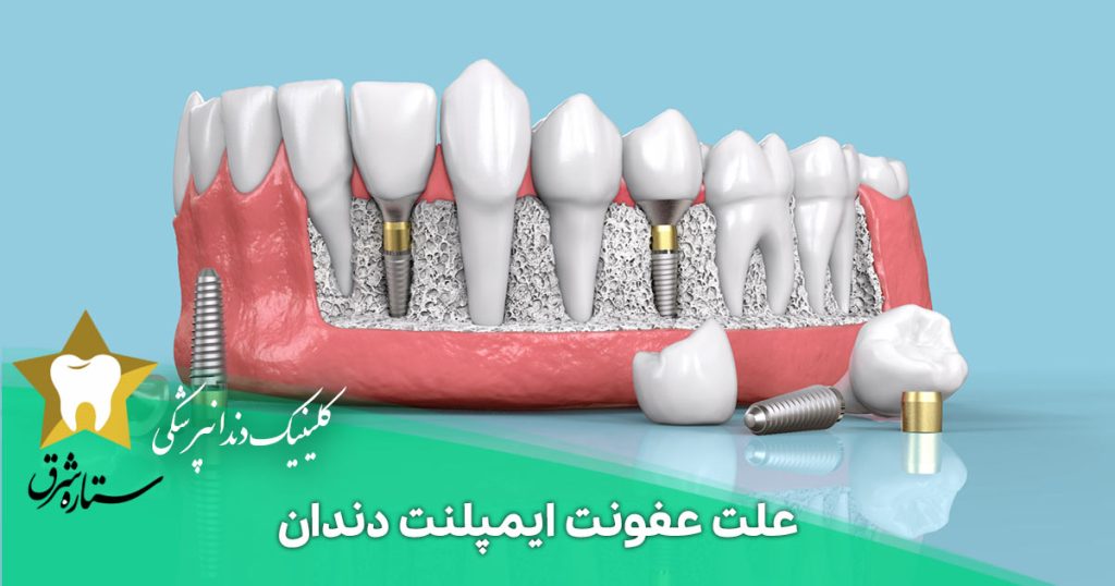علت عفونت ایمپلنت دندان