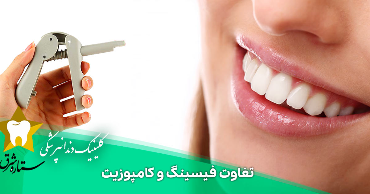 همه چیز درباره تفاوت فیسینگ و کامپوزیت