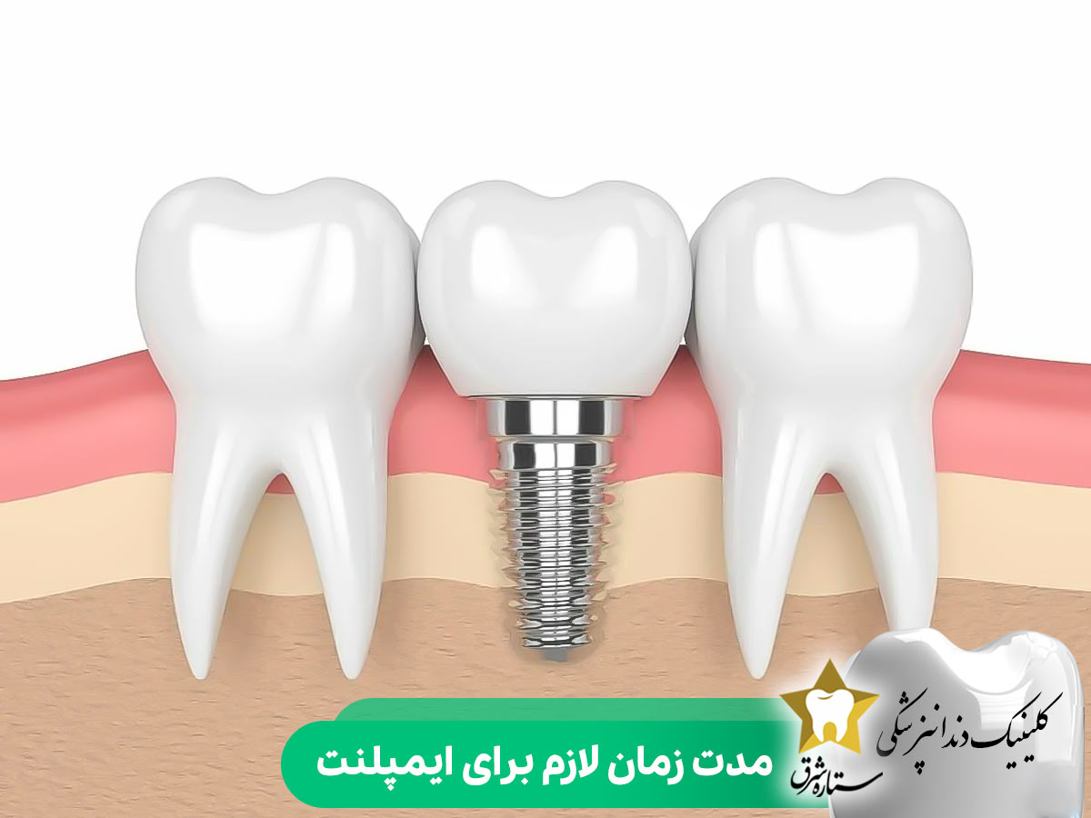 مدت زمان لازم برای ایمپلنت