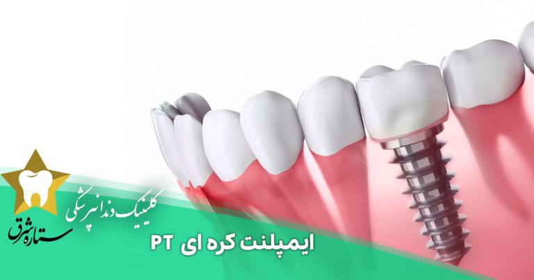 همه چیز درباره ایمپلنت کره ای pt