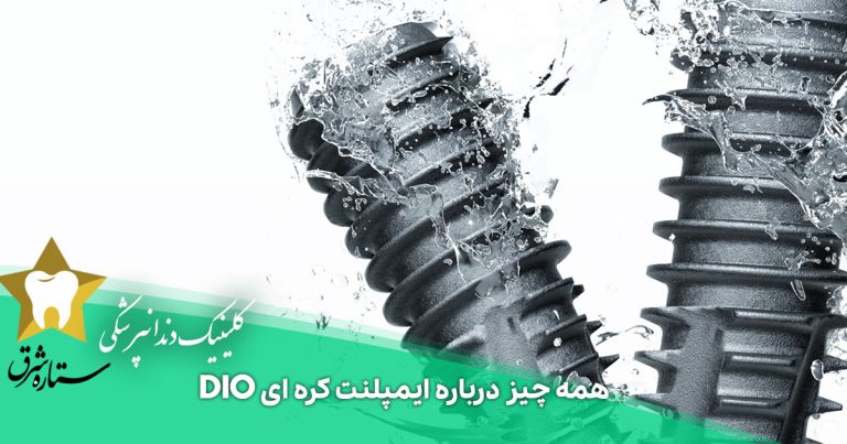 همه چیز درباره ایمپلنت کره ای dio از قیمت تا کیفیت