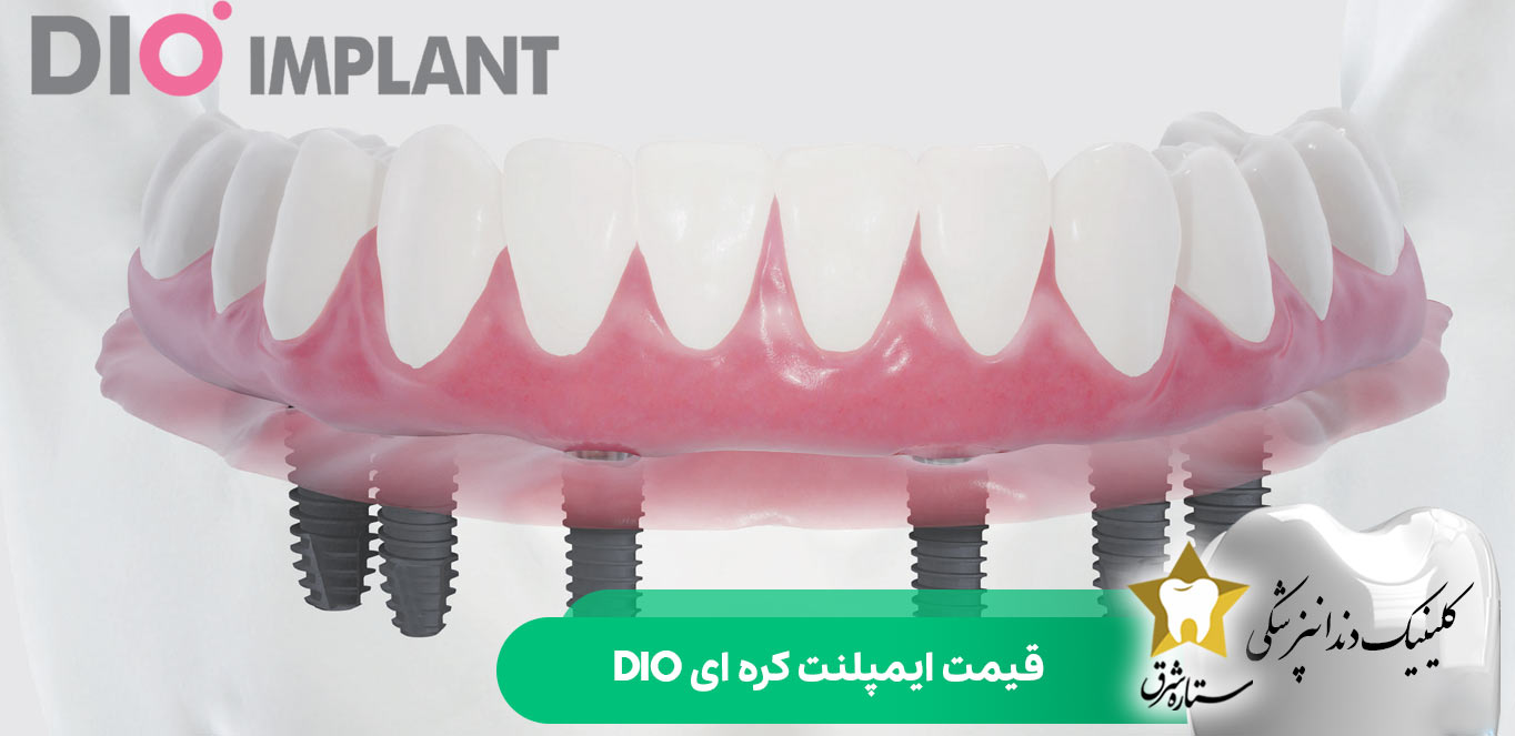 قیمت ایمپلنت کره ای dio