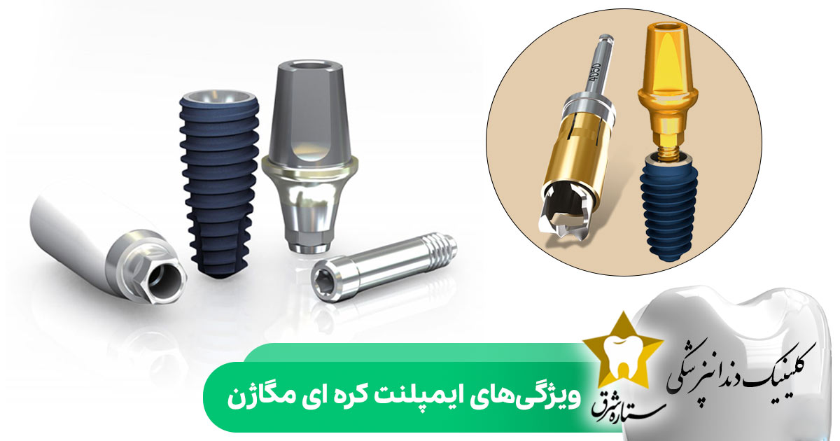 ویژگی های ایمپبنت کره ای مگاژن