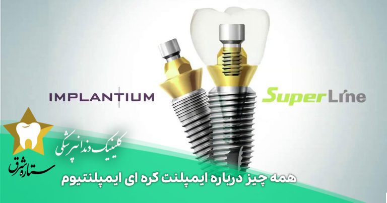 همه چیز درباره ایمپلنت کره ای ایمپلنتیوم