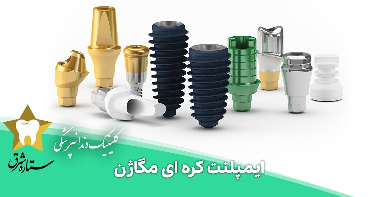 ایمپلنت مگاژن – بررسی کیفیت، مزایا و قیمت