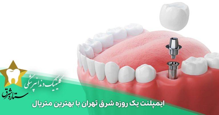 ایمپلنت یک روزه شرق تهران با بهترین متریال