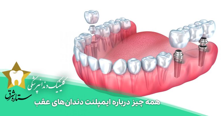 همه چیز درباره ایمپلنت دندان‌های عقب