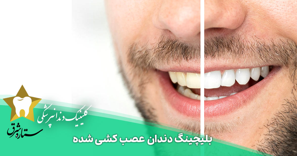 بلیچینگ دندان عصب کشی شده