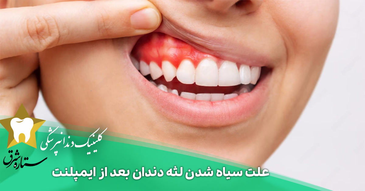 علت سیاه شدن لثه دندان بعد از ایمپلنت چیست؟