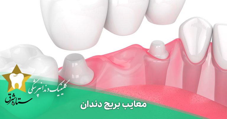 معایب بریج دندان که باید بشناسید