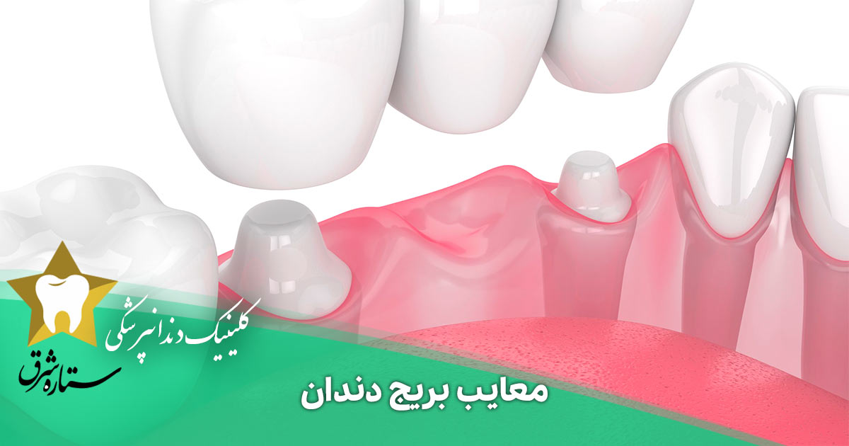 معایب بریج دندان که باید بشناسید
