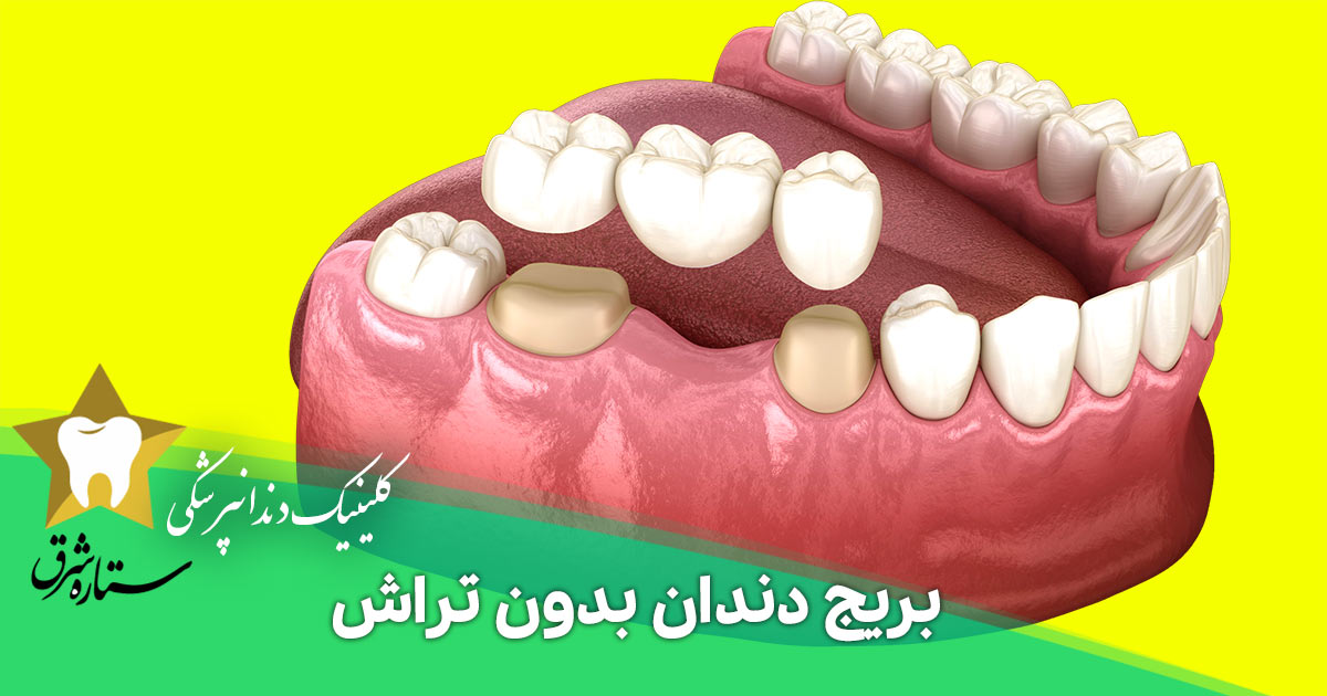 همه چیز درباره بریج دندان بدون تراش