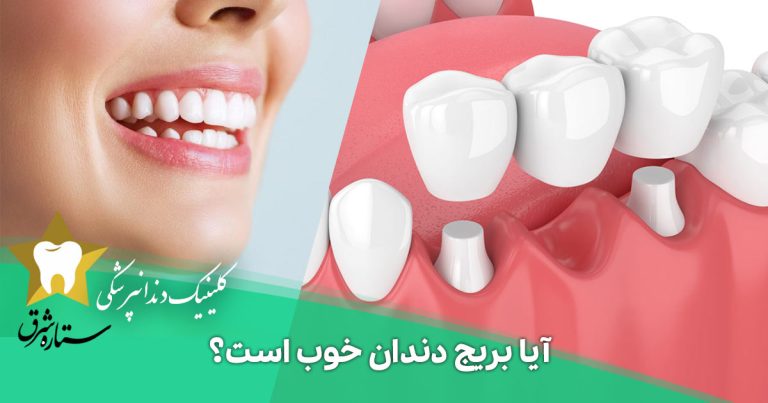 آیا بریج دندان خوب است؟