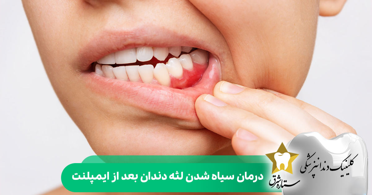 درمان سیاه شدن لثه دندان بعد از ایمپلنت
