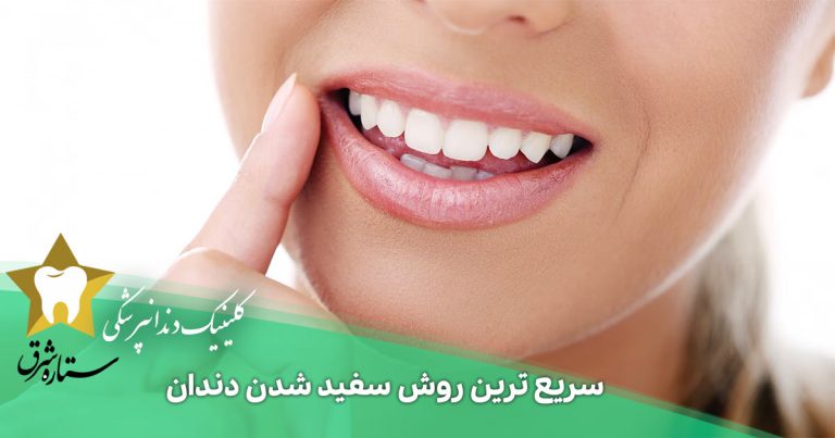 سریع ترین روش سفید شدن دندان را بشناسید