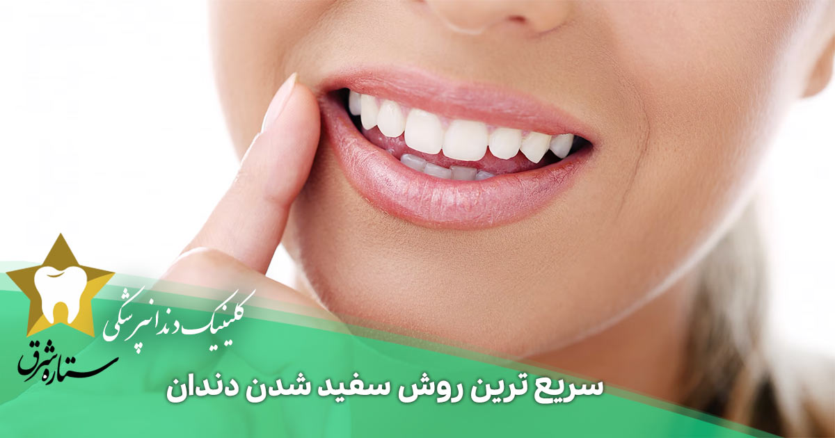 سریع ترین روش سفید شدن دندان را بشناسید