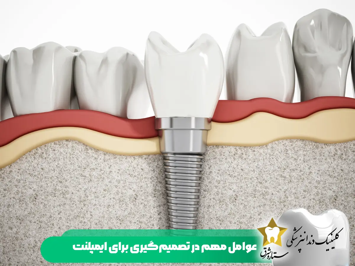 عوامل تعیین کننده سن مناسب ایمپلنت دندان