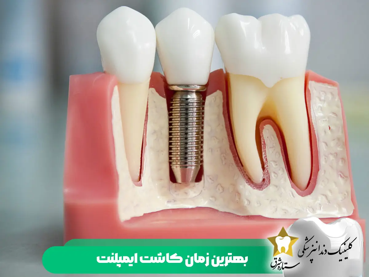 بهترین زمان کاشت ایمپلنت دندان