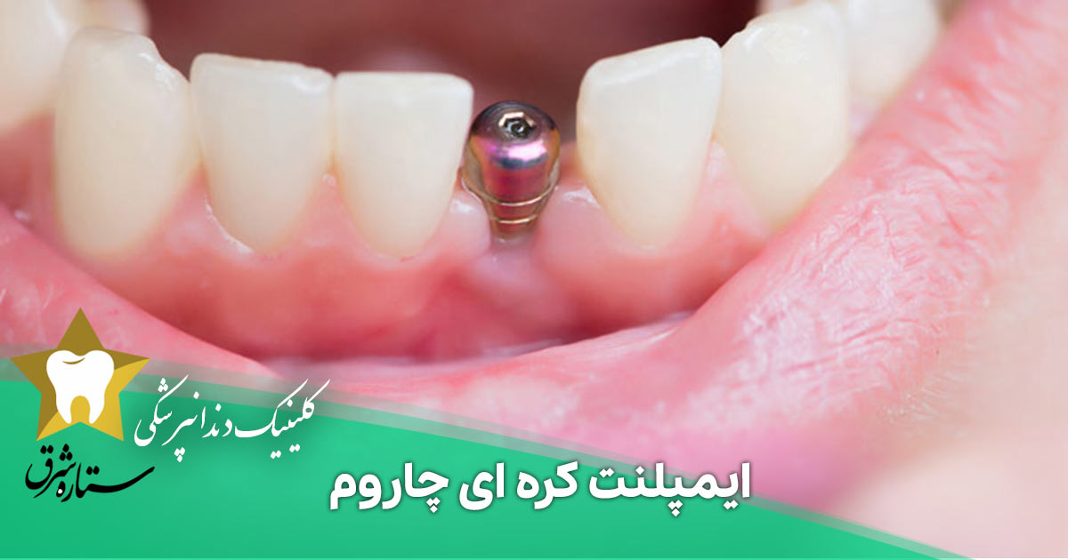 همه چیز درباره ایمپلنت کره ای چاروم