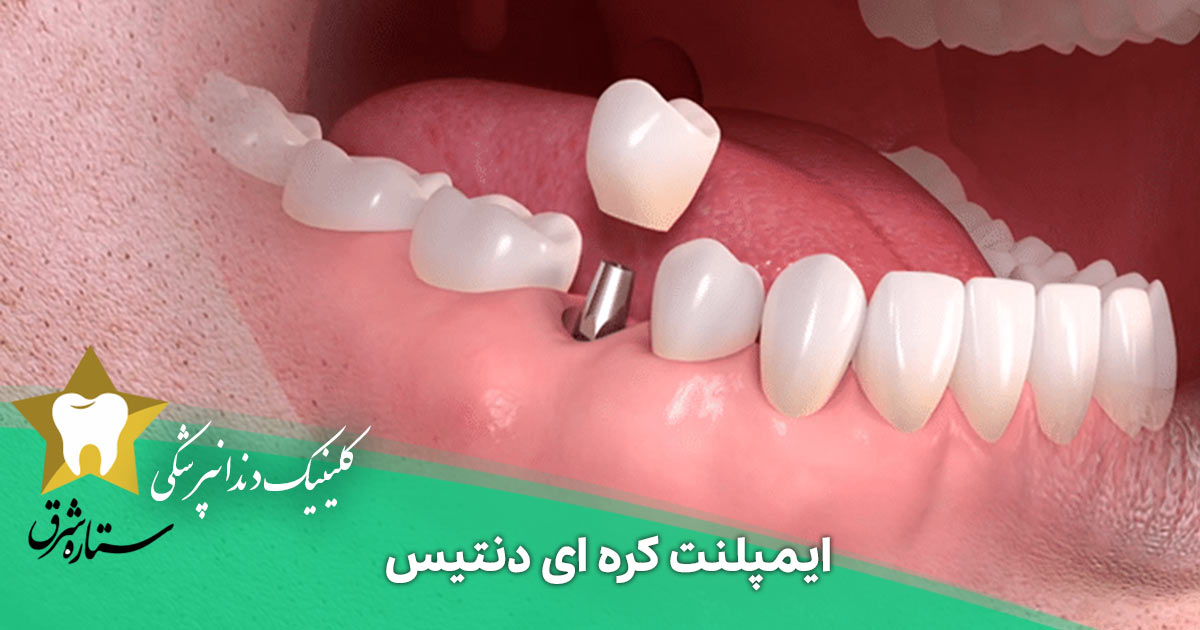 همه چیز درباره ایمپلنت کره ای دنتیس