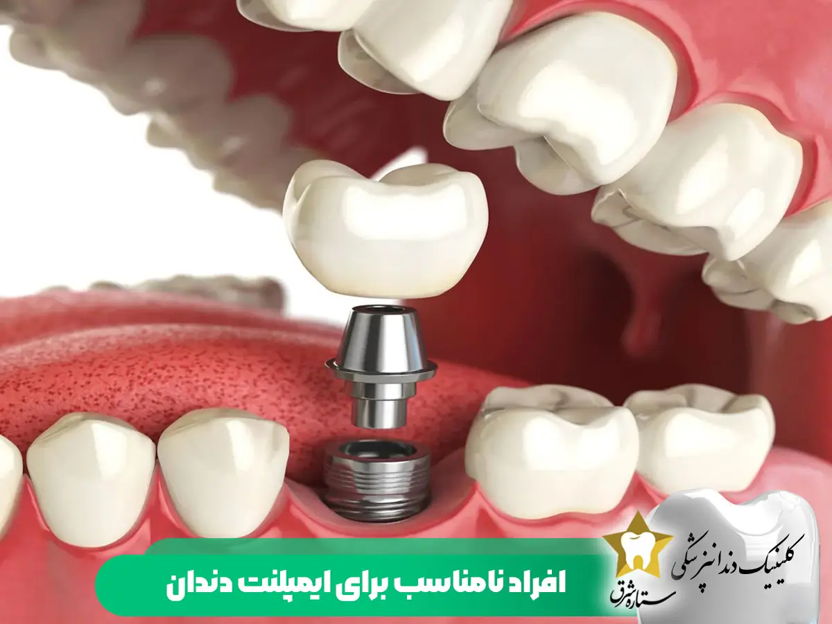 افراد نامناسب برای ایمپلنت دندان