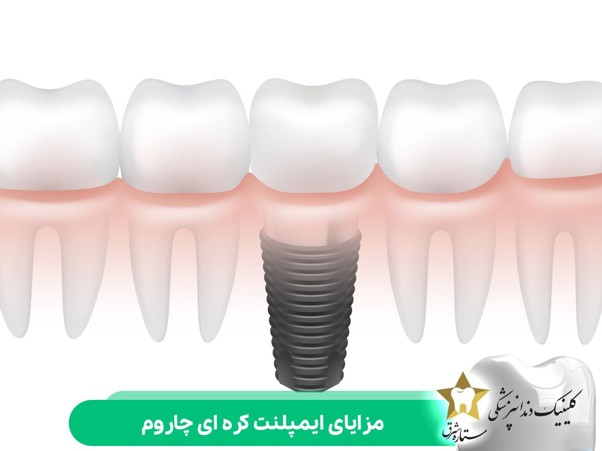 مزایای ایمپلنت کره ای چاروم