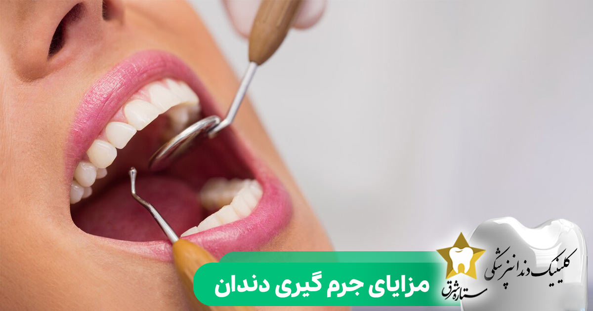 مزایای جرم گیری دندان