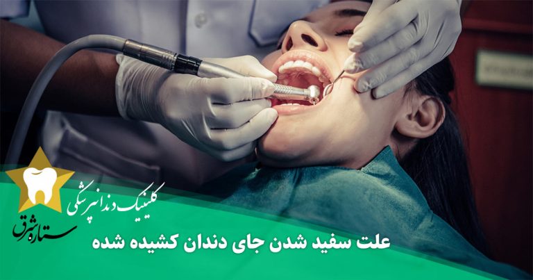 سفید شدن جای دندان کشیده شده نشانه چیست + راهکار درمان